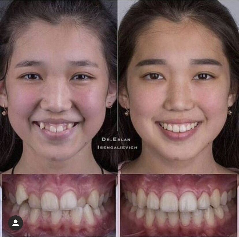 치아교정의 효과