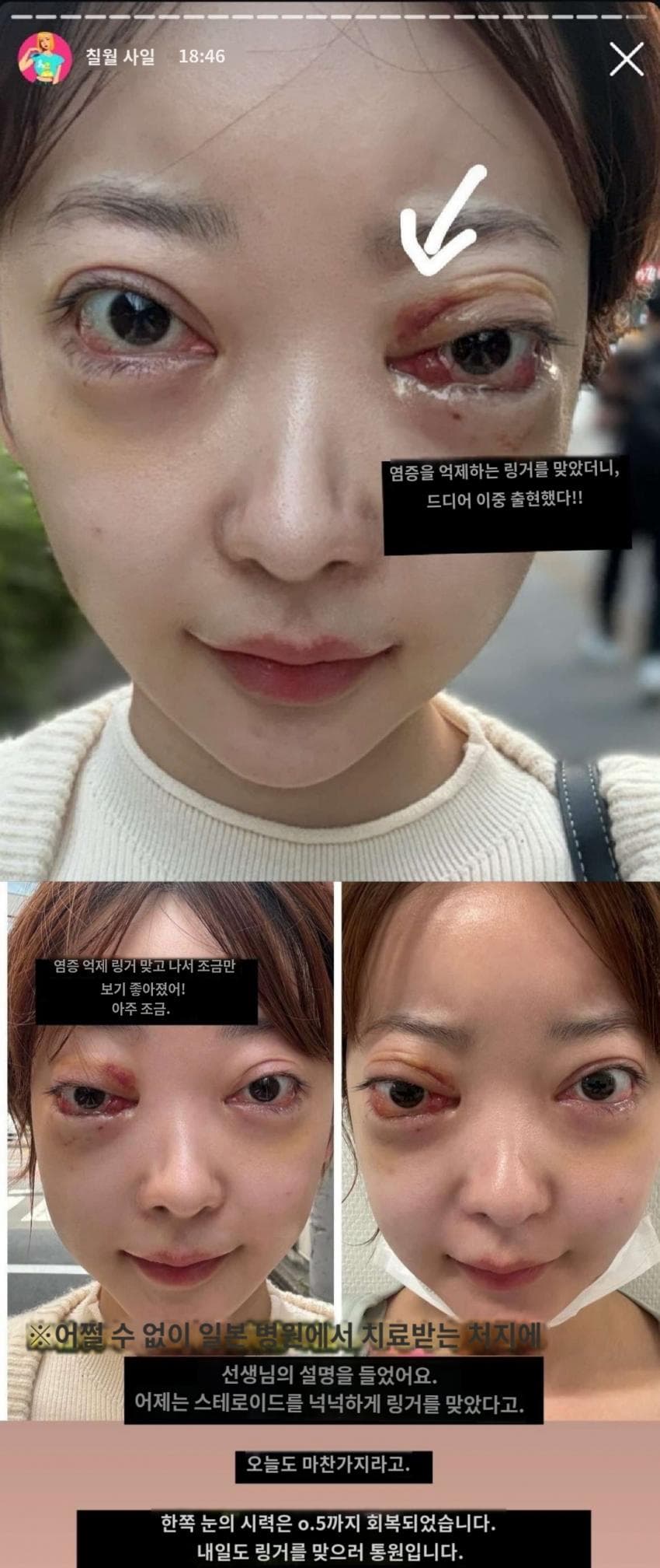 1720328897-1.jpg 약혐)한국에서 성형수술후 부작용,대응 때문에 병원폭로한 일본녀